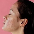 Acne Breakouts: Unmasking the Culprits
