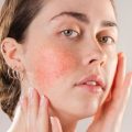 Unmasking the Mystery of Redness and Rosacea